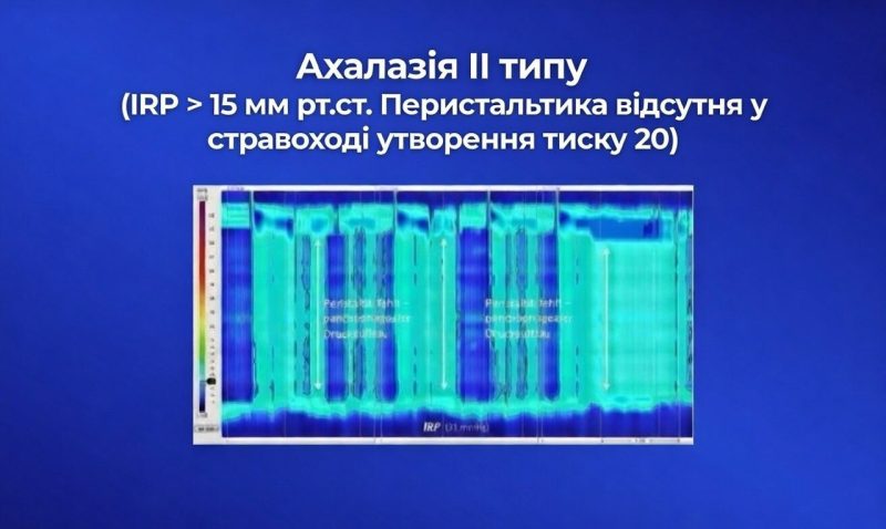 Ахалазія кардії